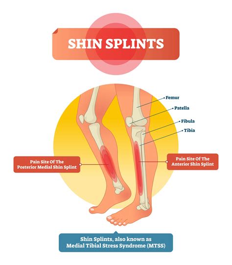 Shin Splints VA Rating Explained: Top 3 Tips to Get a VA Rating for Shin Splints (The Insider’s ...