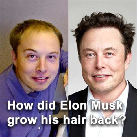 Elon Musk Hair Transplant – An Open Secret - Cosmedica