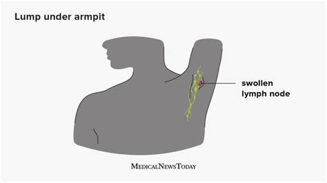 What Causes Breast Lymph Nodes To Enlarge Top Sellers ...