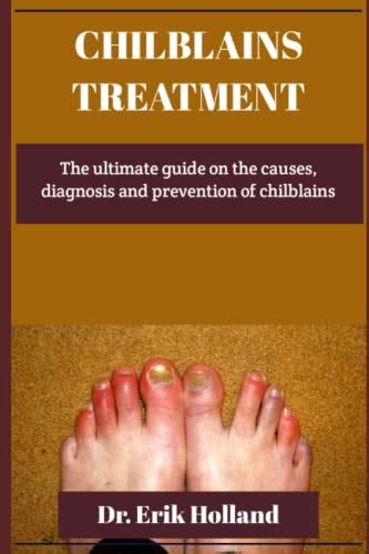 CHILBLAINS TREATMENT: The Ultimate Guide on the Causes, Diagnosis and ...