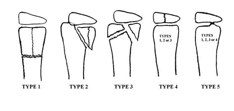 Schematic drawing of the classification system for physeal fractures of... | Download Scientific ...