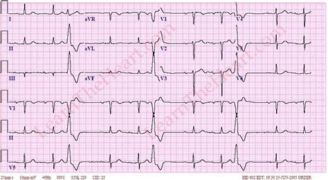 Ventricular Trigeminy ECG (Example 1) | Learn the Heart