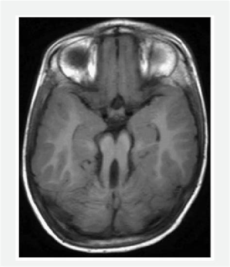 Joubert syndrome. Axial MRI of a 5-year-old boy with delayed... | Download Scientific Diagram