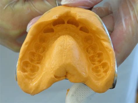 What Every Patient Should Know About Traditional Impressions Vs ...