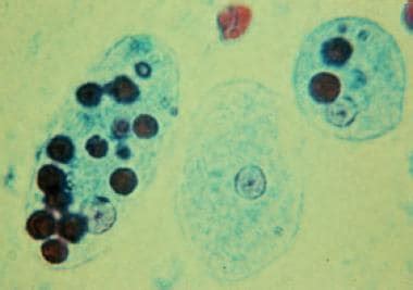 Amebiasis: Background, Pathophysiology, Etiology