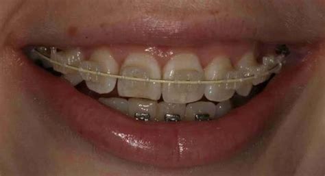 Ceramic Braces, Braces Job Work, ब्रेसेस सर्विस, ब्रेसेस की सेवाएं in ...