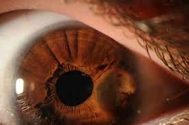 Iridocyclitis and Uveitis - Symptoms Causes and Treatment - Flashy Info