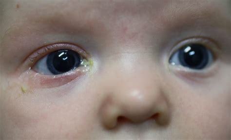 Blocked Tear Duct in Babies-Symptoms, Causes, Diagnosis & Treatment