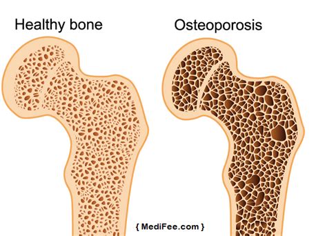 Osteoporosis – Types, Causes, Diagnosis and Preventive Measures