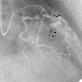 Active extravasation of contrast at the middle portion of the anterior... | Download Scientific ...