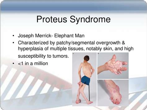 PPT - A Mosaic Activating Mutation in AKT1 Associated With The Proteus ...