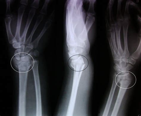 Explaining What Smith's Fracture Is - Physioroom Blog