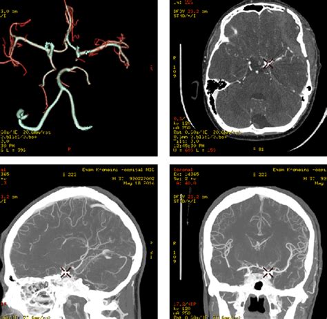 The Diagnostic Value of CT Angiography in the Diagnosis of Residual ...