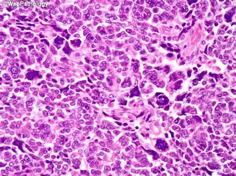 Webpathology.com: A Collection of Surgical Pathology Images