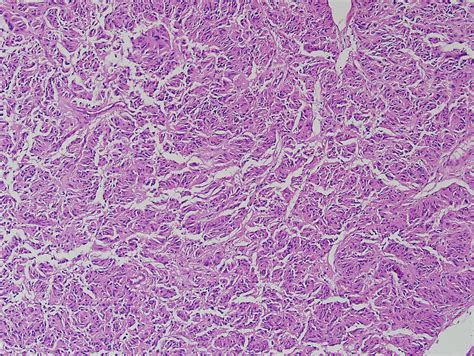 Pathology Outlines - Paraganglioma