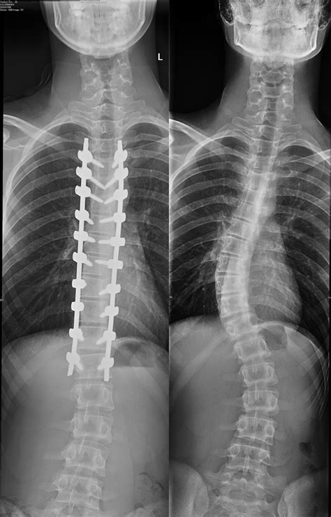 Scoliosis surgery before and after x-rays. : r/pics