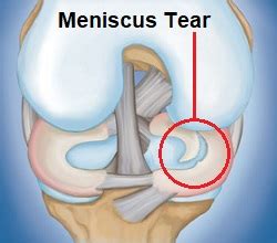 Meniscus Tear Treatment Options - Knee Pain Explained