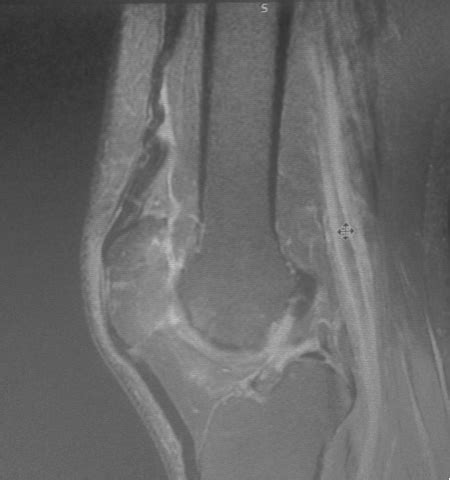 Quadriceps Tendon Tear-MRI - Sumer's Radiology Blog