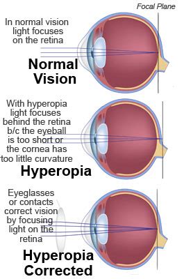 Farsightedness (Hyperopia) - Christopherson Eye Clinic