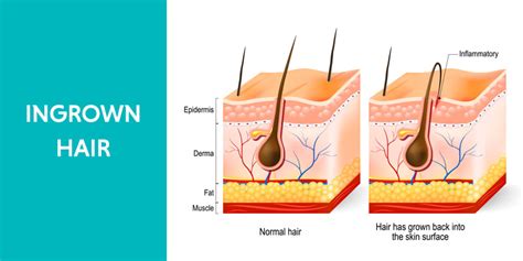 How To Get Rid Of Ingrown Hair: Best Treatments And Preventions