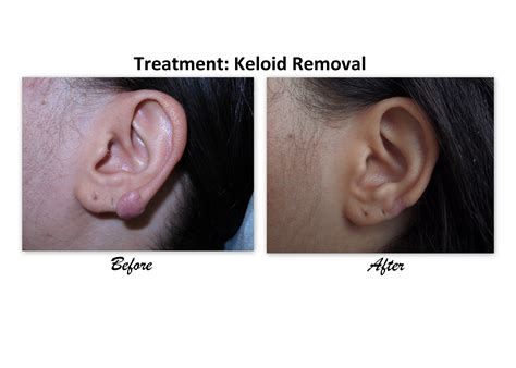 LANAP Dentist in South Side Chicago| Keloid Removal | Dentist South Side Chicago