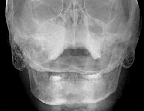 What Is Craniofacial Fibrous Dysplasia? » Head & Neck Surgical Associates