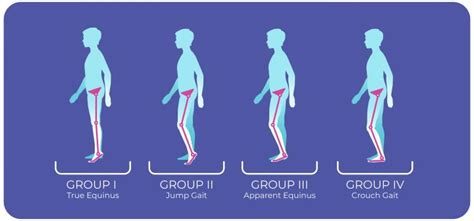 Gait Patterns in Cerebral Palsy Fact Sheet | Cerebral Palsy Foundation