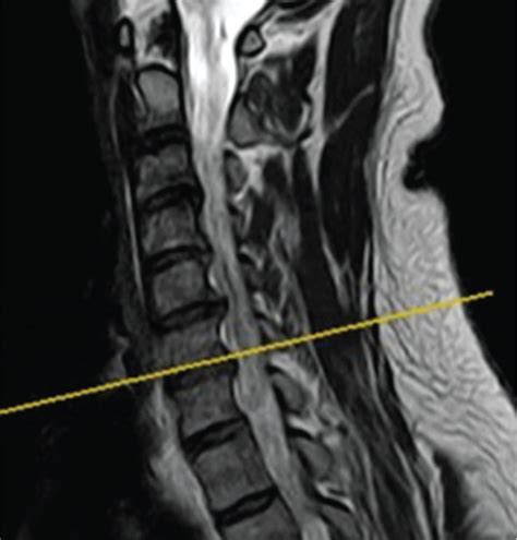 Cervical intervertebral foraminal stenosis at C6-7 level. The ...