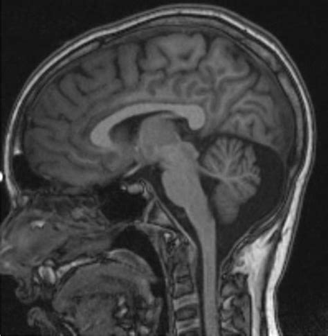 Sagittal T1-weighted cerebral MRI scan showing vermian hypoplasia ...