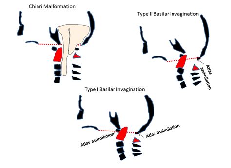 Basilar Invagination: cranio-cervical kyphosis rather than prolapse from the upper cervical spine