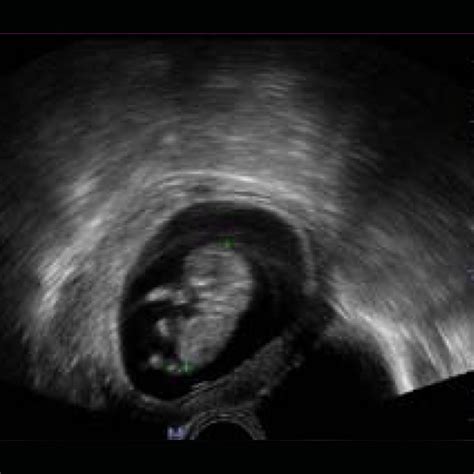 dp-50-fetus intravaginal – Northwest Ultrasound