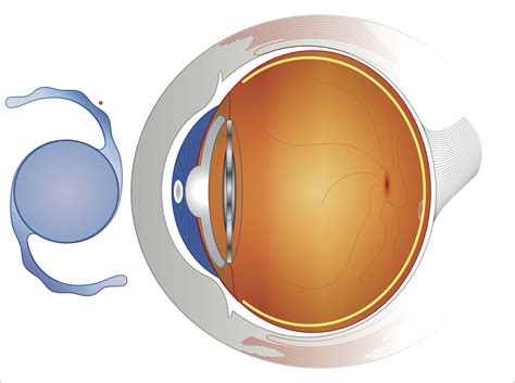 Cataract Surgery - Dr Lynn Yeo | Experienced Eye Surgeon, Singapore