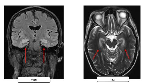 Bilateral Hippocampal Infarction