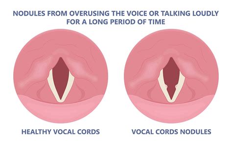 Vocal Cord Nodules: How to Avoid Them and Maintain a Healthy Singing ...