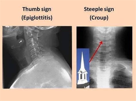 Meddy Bear - #thumb #sign vs. #Steeple sign...