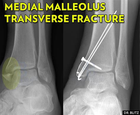 Lateral Malleolus Avulsion Fracture