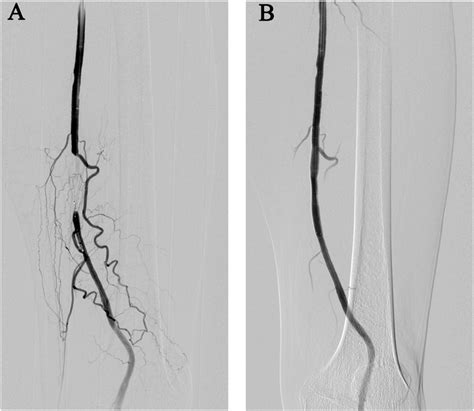 -Left SFA occlusion and stent deployment. (A) DSA. Left SFA occlusion... | Download Scientific ...