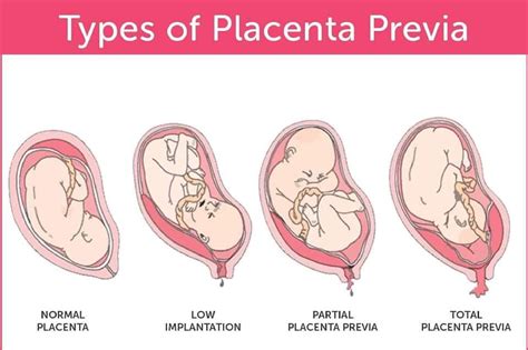 SOLUTION: Placenta previa nursing notes - Studypool