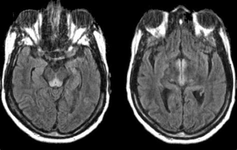 Dr Balaji Anvekar FRCR: Wernicke's Encephalopathy MRI