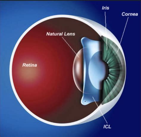 Implantable Contact Lens (ICL) Specialist - Manhattan, NY, & Long Beach ...