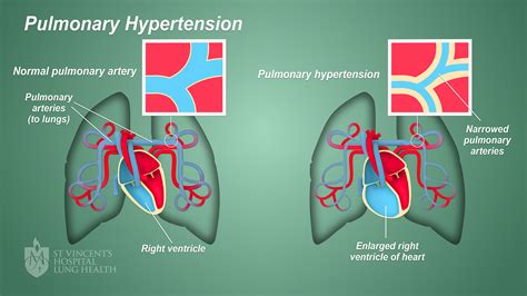 Pathogenesis Of Pulmonary Arterial Hypertension Lesso - vrogue.co