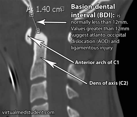 Atlanto-Occipital Dislocation (Internal Decapitation) - VirtualMedStudent.com