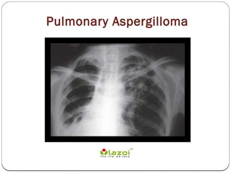 Pulmonary Aspergilloma: Causes, Symptoms, Daignosis, Prevention and Treatment by lazoithelife ...