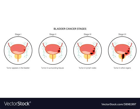 Bladder cancer stages Royalty Free Vector Image