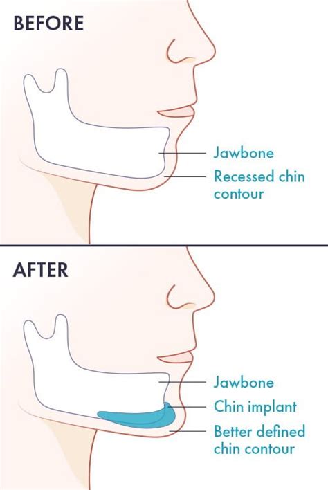 Chin Implant Surgery | American Board of Cosmetic Surgery | Jaw Contouring for Men & Women