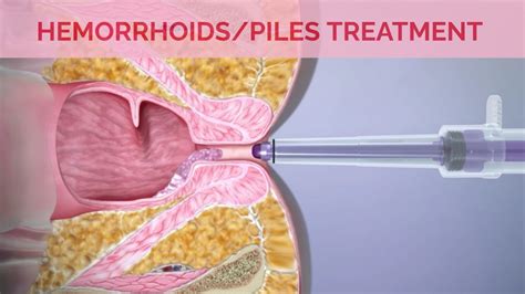 Hemorrhoids Removal Surgery I Hemorrhoid Treatment with Laser Surgery & Rubber Band Ligation ...