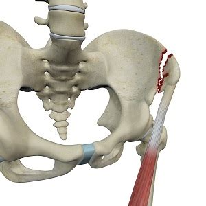 Avulsion Fractures of the Pelvis Salem, OR | Unstable Pelvic Fractures Corvallis, OR