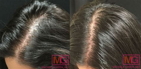 Top 141 + Prp hair restoration before and after - polarrunningexpeditions