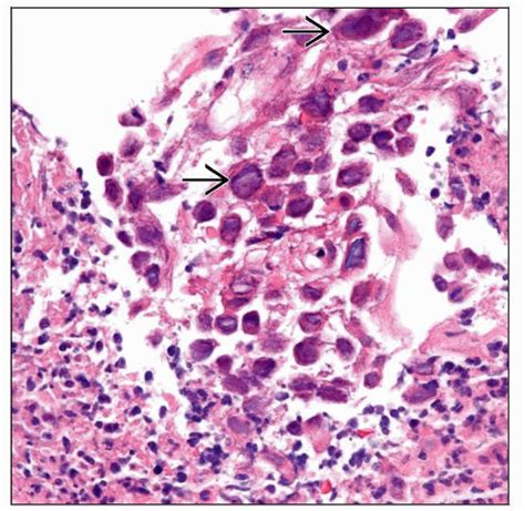 Herpes Simplex Virus Esophagitis | Basicmedical Key