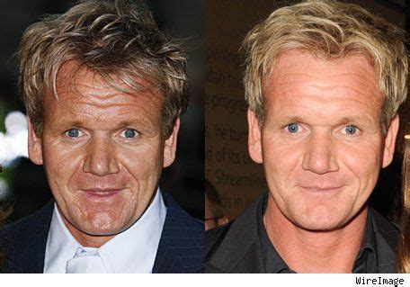 Gordon Ramsay Plastic Surgery Before And After Botox